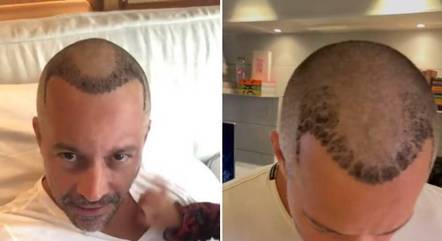 Malvino Salvador mostra resultado de transplante capilar