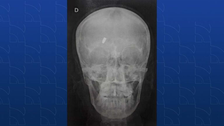 Mulher sente dor de cabeça e descobre que levou um tiro e tinha uma bala no crânio
