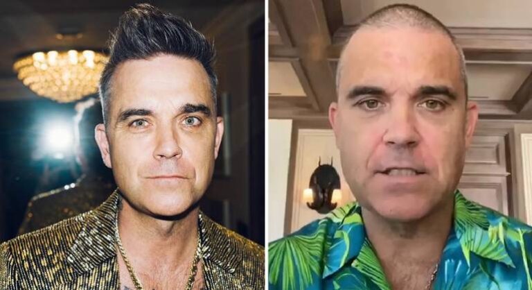 Transplante de Robbie Williams dá errado e ele pensa em usar peruca
