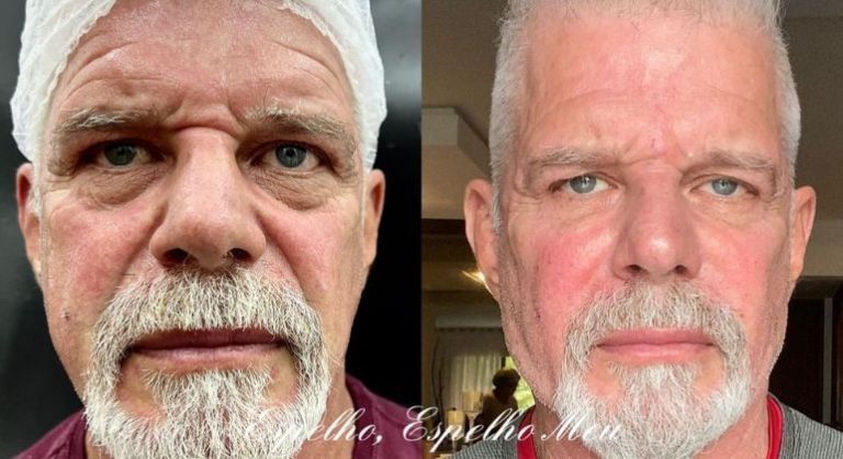 Raul Gazolla mostra antes e depois de harmonização facial